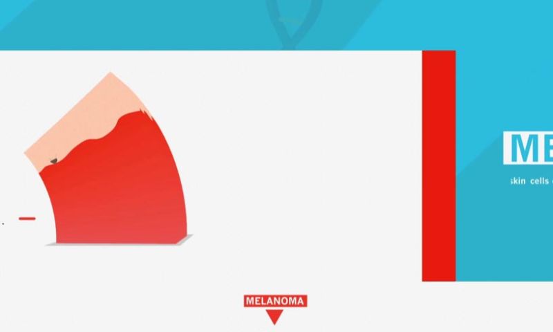 Explaining Advanced Melanoma